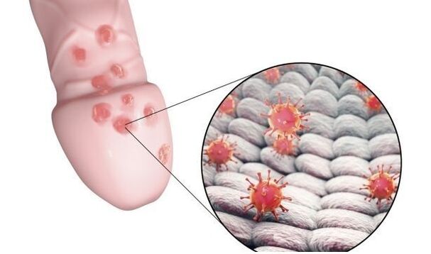 alergie la gelul pentru marirea penisului