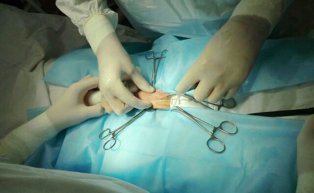 Intervenția chirurgicală asupra organului reproducător va ajuta la creșterea dimensiunii acestuia